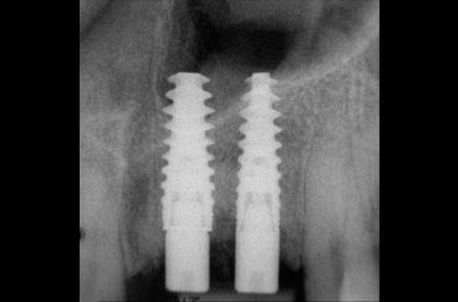 Radiographie de contrôle d’un implant posé après une pénétration délibérée dans le sinus